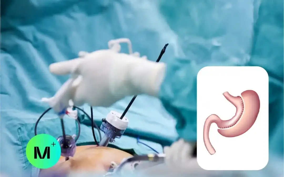 Los Beneficios y Proceso de la Manga Gástrica: Un Enfoque Profundo desde la Perspectiva de la Cirugía Bariátrica